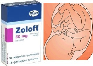 Zoloft Birth Defect